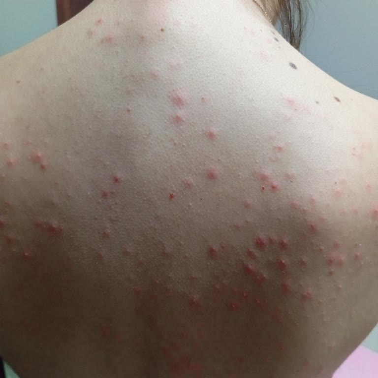 Lazer Epilasyonda Hayal Kırıklığı