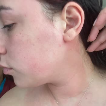 L’Oréal Paris Sunscreen Burned My Face