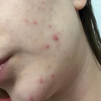 Caudalie Ürünleri Cildimde Kırmızı Lekelere Neden Oldu