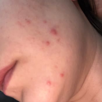 Caudalie Ürünleri Cildimde Kırmızı Lekelere Neden Oldu