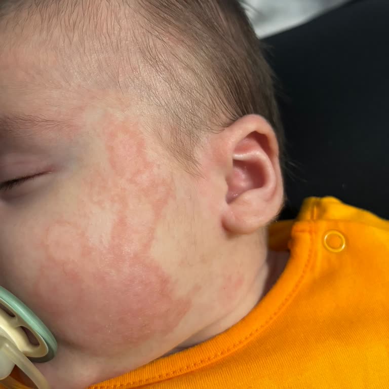 Bebek Şampuanı Alerjik Reaksiyon Yarattı