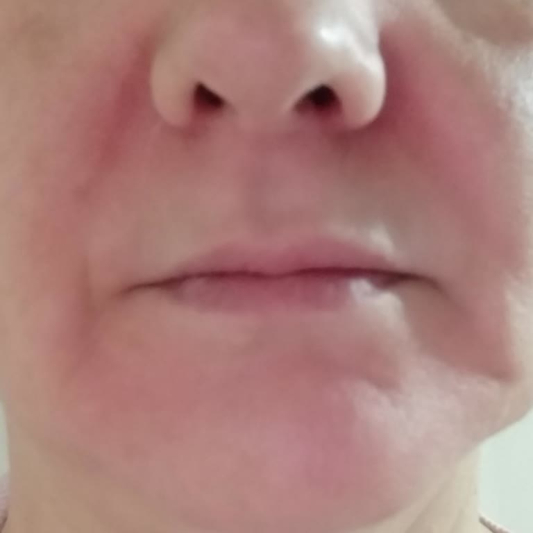 Estée Lauder Product Caused Severe Skin Reaction