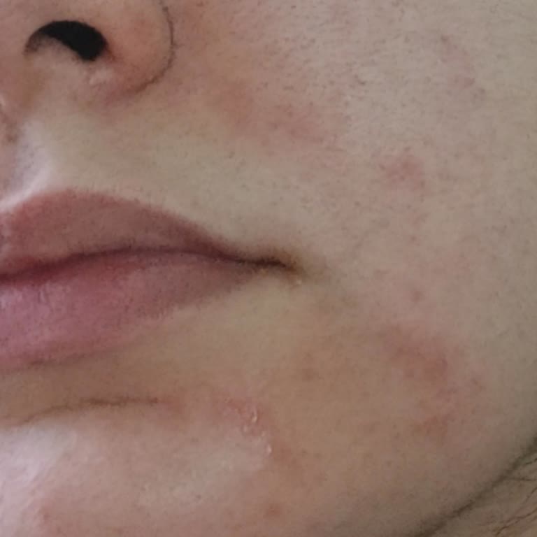 Neutrogena Face Wash Caused Severe Itching & Allergic Reaction