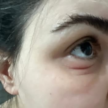 Estee Lauder Göz Kremi Yanma Ve Kızarıklık Yapıyor