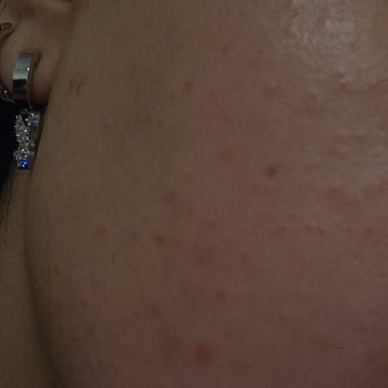 Yanıltıcı Ürün Tavsiyesi Ve Cilt Sorunları