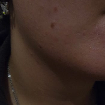 Yanıltıcı Ürün Tavsiyesi Ve Cilt Sorunları