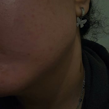 Yanıltıcı Ürün Tavsiyesi Ve Cilt Sorunları