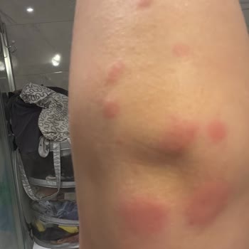 Rossmann Dr. Beckmann Leke Çıkarıcı Cilt Sorunlarına Yol Açtı!