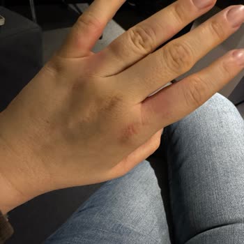 Rossmann Dr. Beckmann Leke Çıkarıcı Cilt Sorunlarına Yol Açtı!