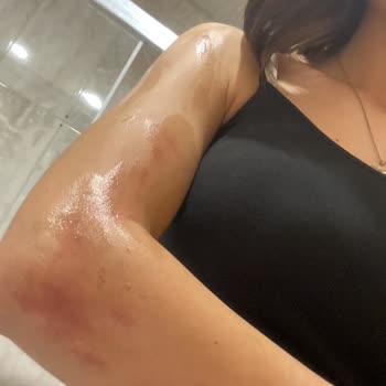 Liva Vip Güzellik Merkezi Giresun Yanlış Lazer Epilasyon Deneyimi