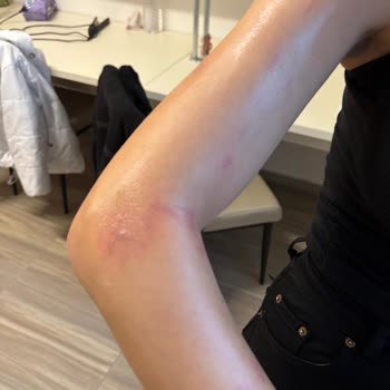 Liva Vip Güzellik Merkezi Giresun Yanlış Lazer Epilasyon Deneyimi