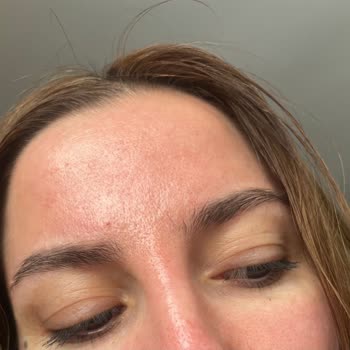 Tehlikeli Serum: Ciltte Kızarıklık Ve Yanma