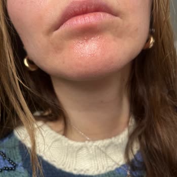 Tehlikeli Serum: Ciltte Kızarıklık Ve Yanma