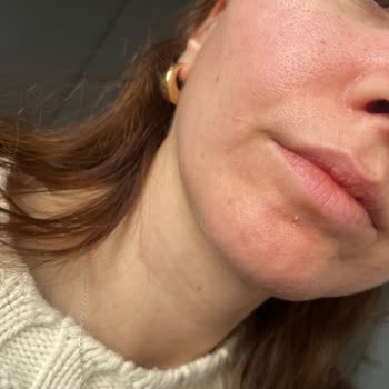 Tehlikeli Serum: Ciltte Kızarıklık Ve Yanma