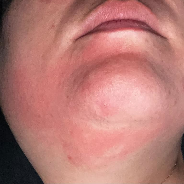 Eyüp Sabri Tuncer Gül Suyu Alerjisi: Beklenmedik Kaşıntı Ve Yanma