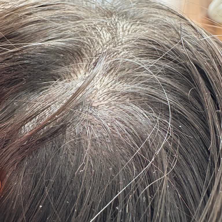 Kepek Ve Yıpranma: Beklenmedik Saç Sorunları