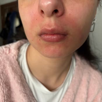 Yves Rocher Ciltte Alerji Ve Sivilce Patlaması: Hayal Kırıklığı!