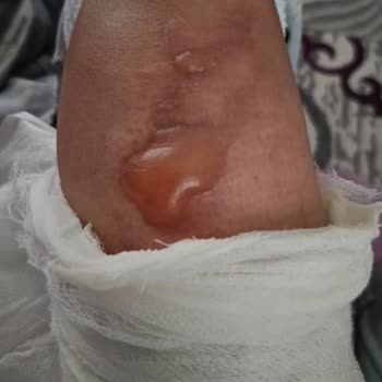 Yanık Tedavisinde Yetersiz İlgi Ve Destek