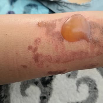 Yanık Tedavisinde Yetersiz İlgi Ve Destek