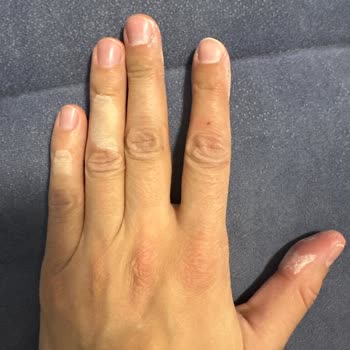 Vanish Kosla Kullanımı Sonrası Cilt Sorunları