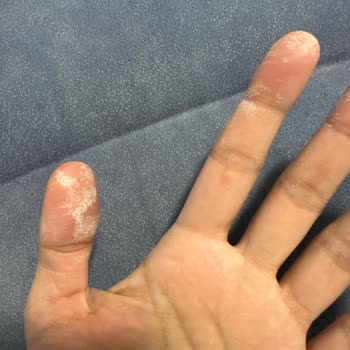 Vanish Kosla Kullanımı Sonrası Cilt Sorunları