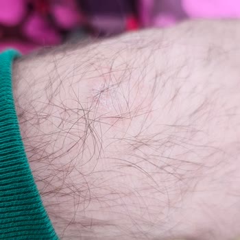 Samsung Galaxy Watch 6 Cilt Sorunu