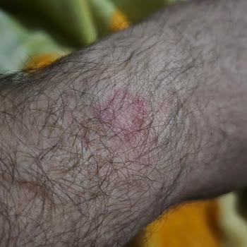 Samsung Galaxy Watch 6 Cilt Sorunu