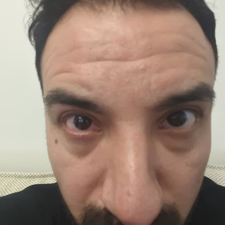 Novaqua Göz Damlası: Yanma Ve Acı Deneyimi