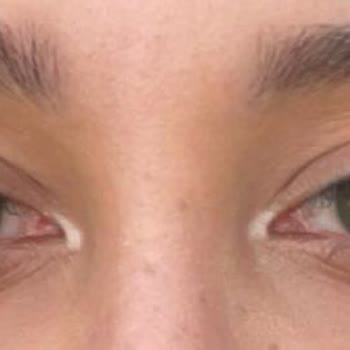 Labella Lenslerinin Kalite Düşüşü Ve Rahatsızlık Sorunu