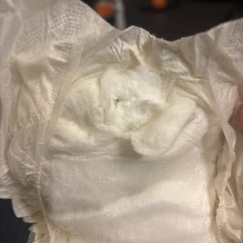 Bebek Bezinde Tebeşir Benzeri Sertlik Şoku