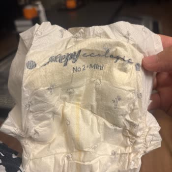 Bebek Bezinde Tebeşir Benzeri Sertlik Şoku