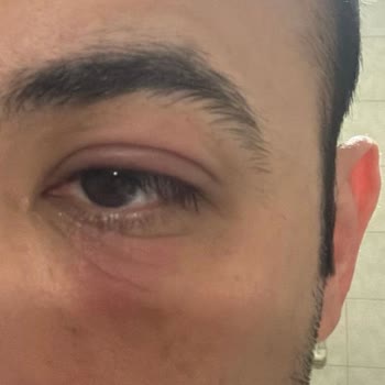 Göz Altı Serumu Şişlik Ve Kızarıklık Yaptı