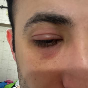 Göz Altı Serumu Şişlik Ve Kızarıklık Yaptı