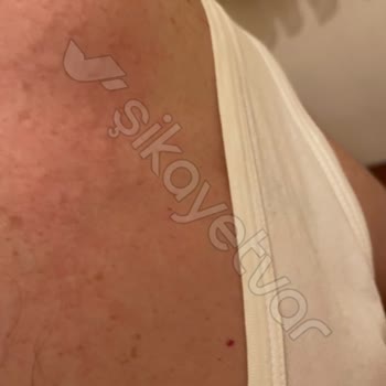 Snickers Caused Severe Skin Reaction – Covered in Rashes & Itching Nonstop