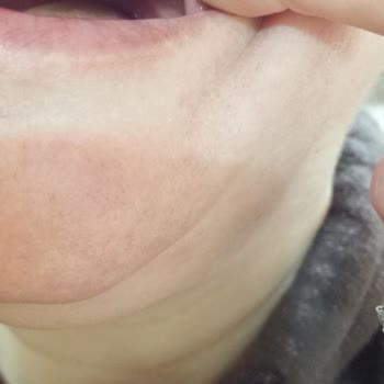 Diş Çekiminde Kalan Parça Ve Doktorun İlgisizliği