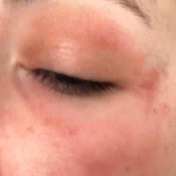 Loreal Paris Serumları Yüzümde Yanık Ve Şişmelere Neden Oldu