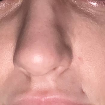 Op. Dr. Onur Tüylü'ye Burun Ameliyatı Oldum, Pişmanım!