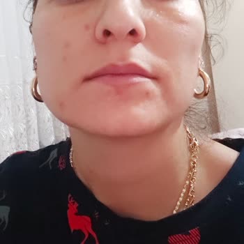 Caudalie Ürünleri Cildimi Tahriş Etti Ve Yara Oluşturdu