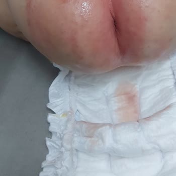 Molfix Bebek Bezi Pişik Sorunu