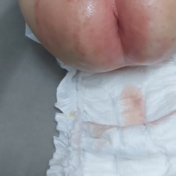 Molfix Bebek Bezi Pişik Sorunu