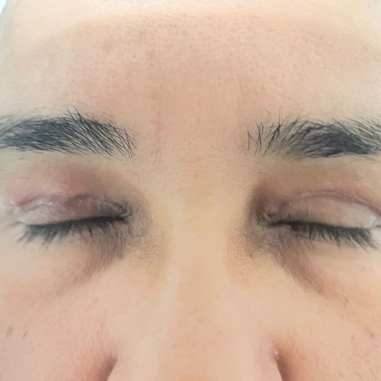 Göz Kapağı Ameliyatında Hayal Kırıklığı