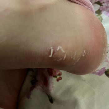 Ayağımı Yaralayan Botlar Ve İade Sorunu