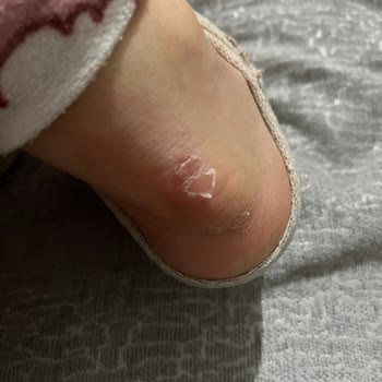 Botlar Ayağımı Mahvetti, Değişim Talebim Reddedildi!