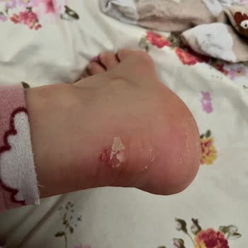 Botlar Ayağımı Mahvetti, Değişim Talebim Reddedildi!