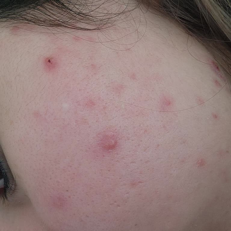 Yves Rocher Sebo Vegetal Jel Krem: Hayal Kırıklığı Ve Cilt Sorunları