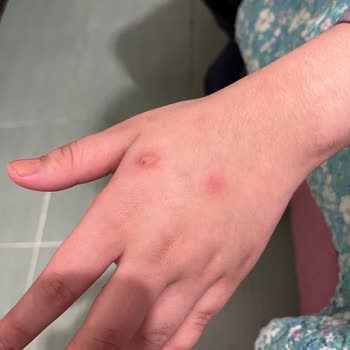 Rexona Clinical Protection Caused Burns on My Daughter’s Hand