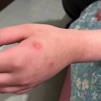 Rexona Clinical Protection Caused Burns on My Daughter’s Hand