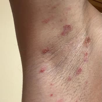 Rexona Cobalt Dry Roll-On Caused Blisters and Skin Irritation