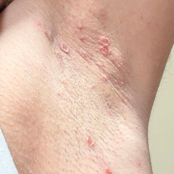 Rexona Cobalt Dry Roll-On Caused Blisters and Skin Irritation