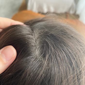 Egzamalı Cilt İçin Uygun Olmayan Ürünler